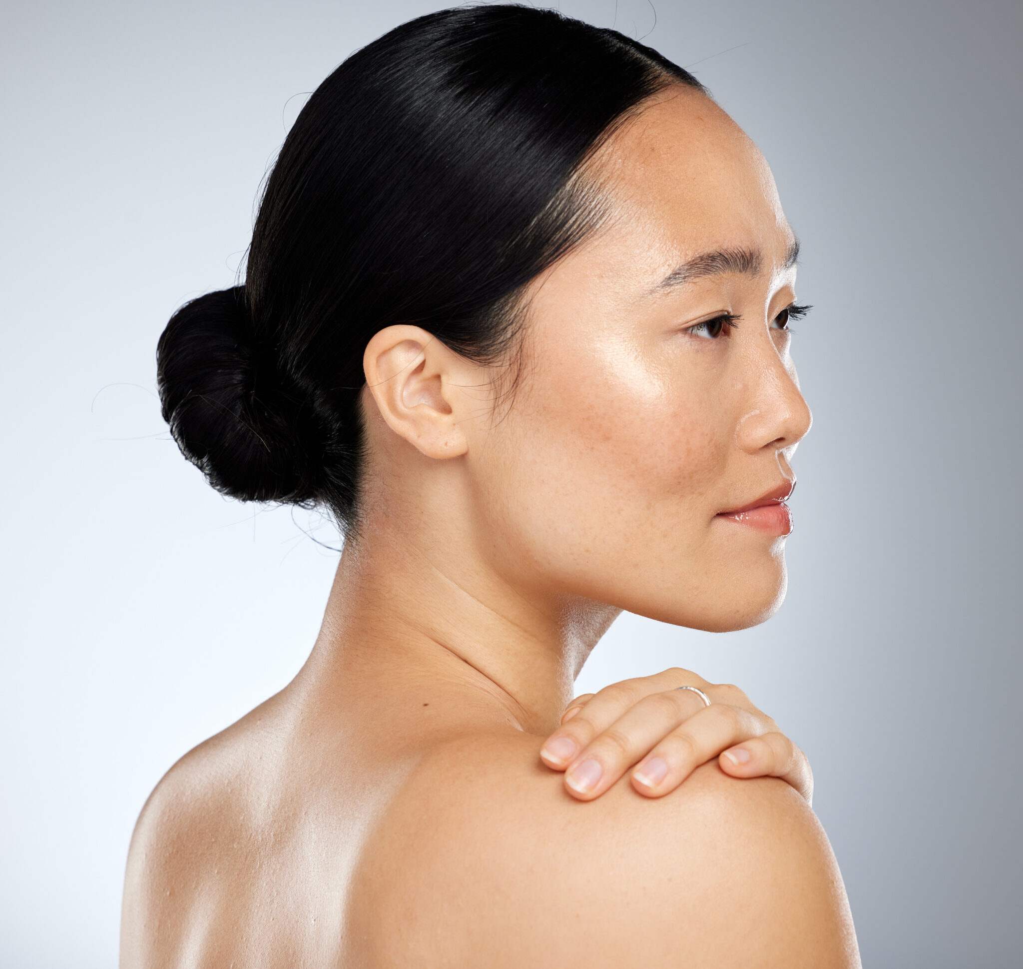 Phân loại sắc tố: nám da & thâm mụn - Lona Skin Lab