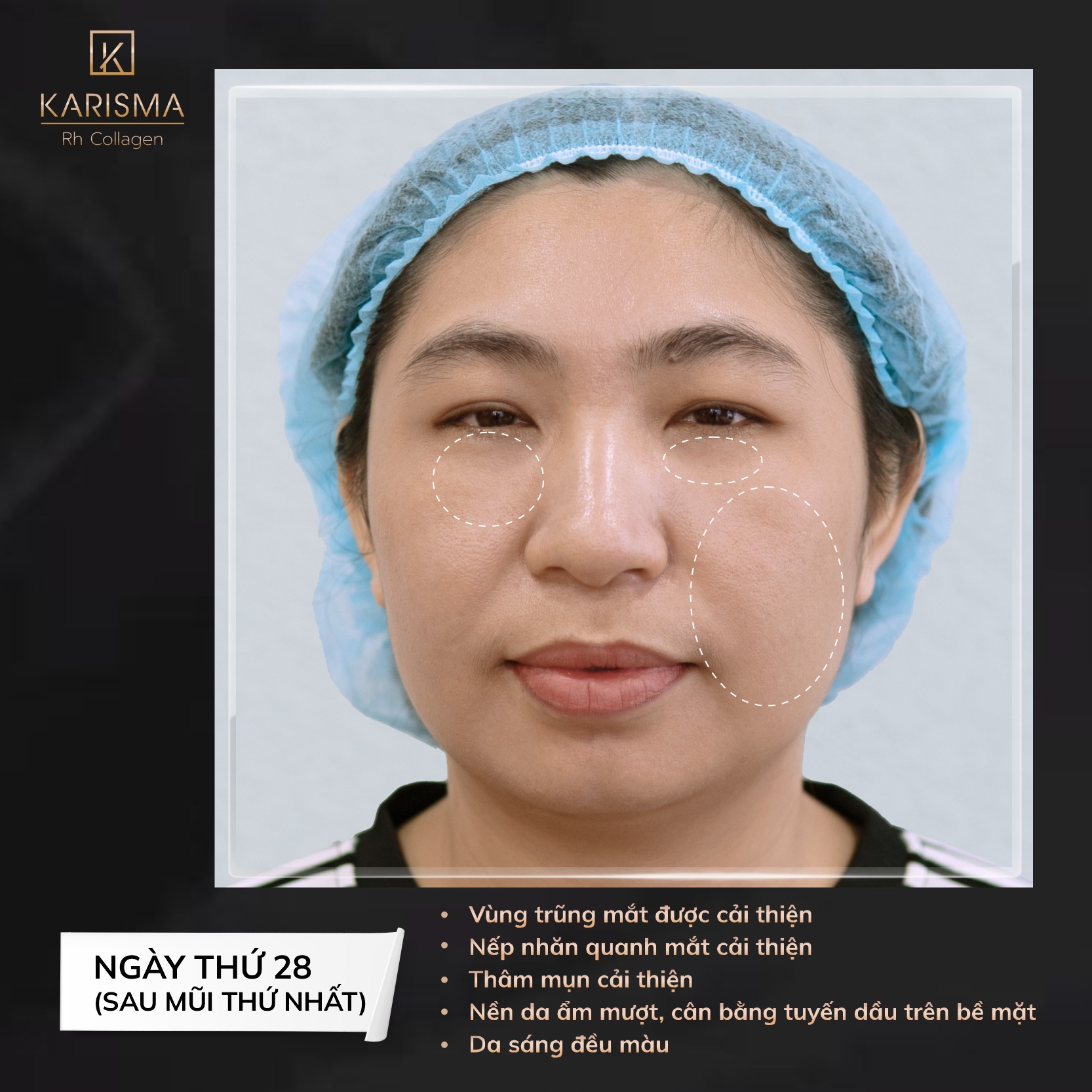 Ảnh chụp này làm rõ vai trò của tiêm karisma trong thẩm mỹ, đồng thời đề cập đến 'karisma của nước nào' và công dụng karisma trong điều trị da.