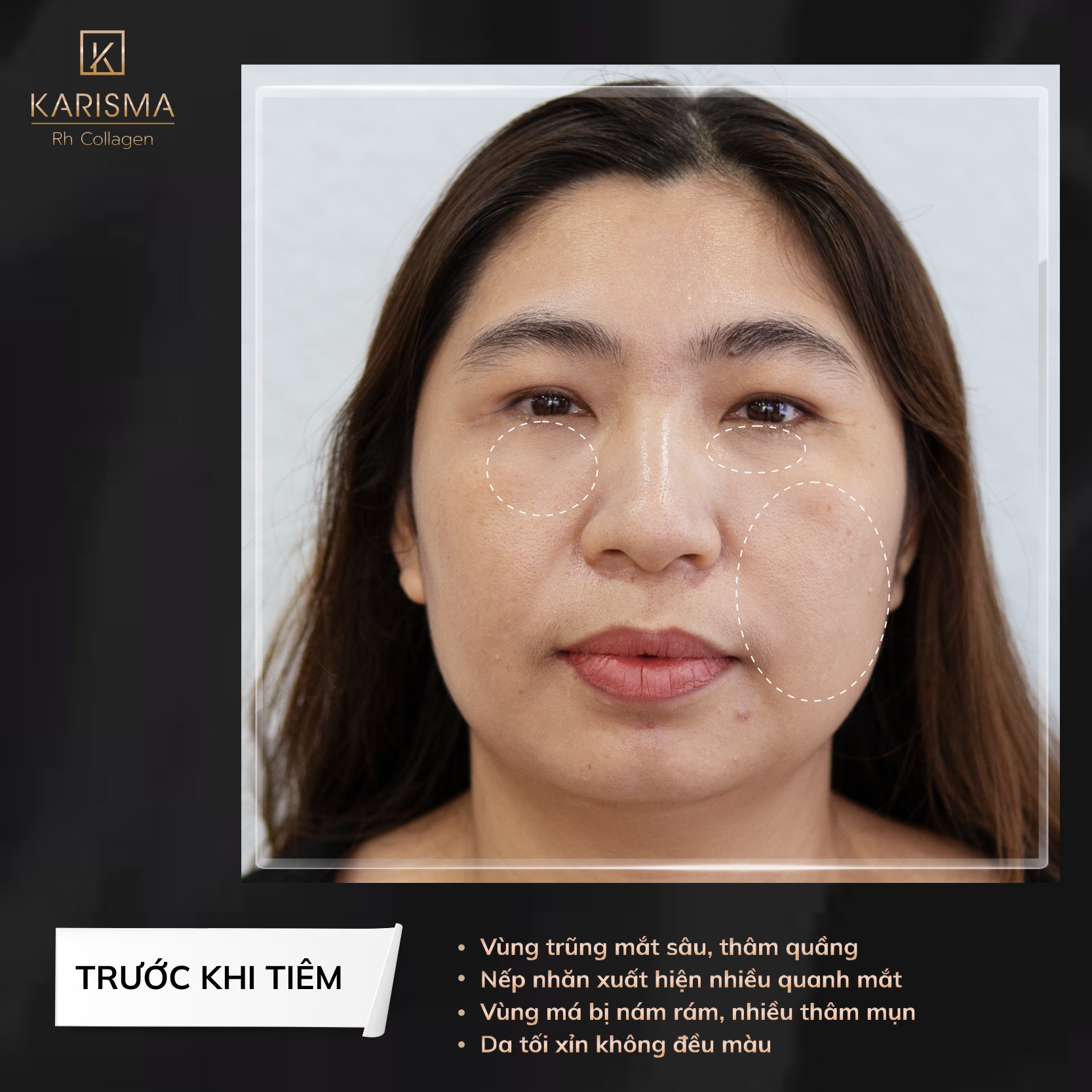 Bức ảnh thể hiện kết quả sau khi tiêm karisma, làm nổi bật sự thay đổi tự nhiên khi 'karisma có tác dụng gì' cho làn da.