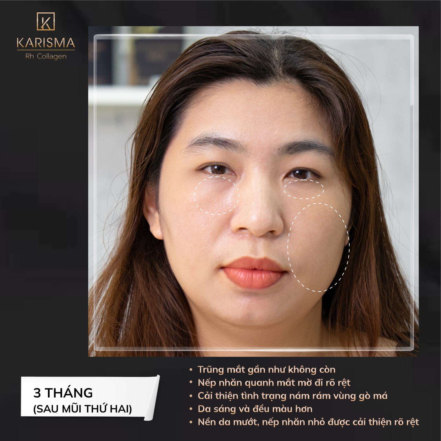 Hình minh họa quy trình chăm sóc da với tiêm karisma, gợi mở câu hỏi 'karisma có phải filler không' qua hiệu quả tự nhiên của sản phẩm.