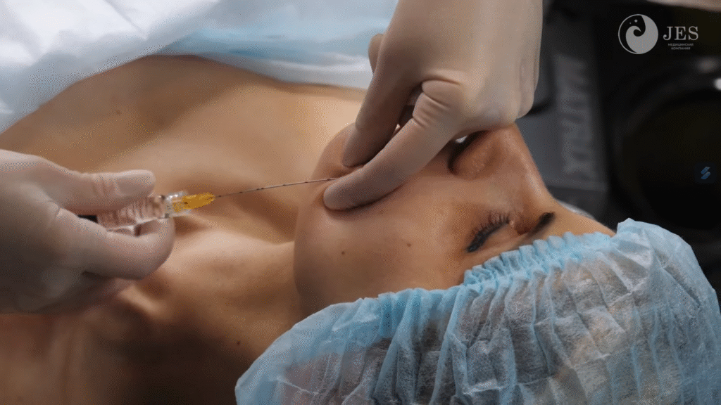 Phương pháp Tiêm Karisma có tác dụng không với vùng cằm được minh chứng qua kỹ thuật tiêm vi điểm, và Tiêm Karisma vùng cằm góp phần làm đầy vùng cằm đôi một cách an toàn.