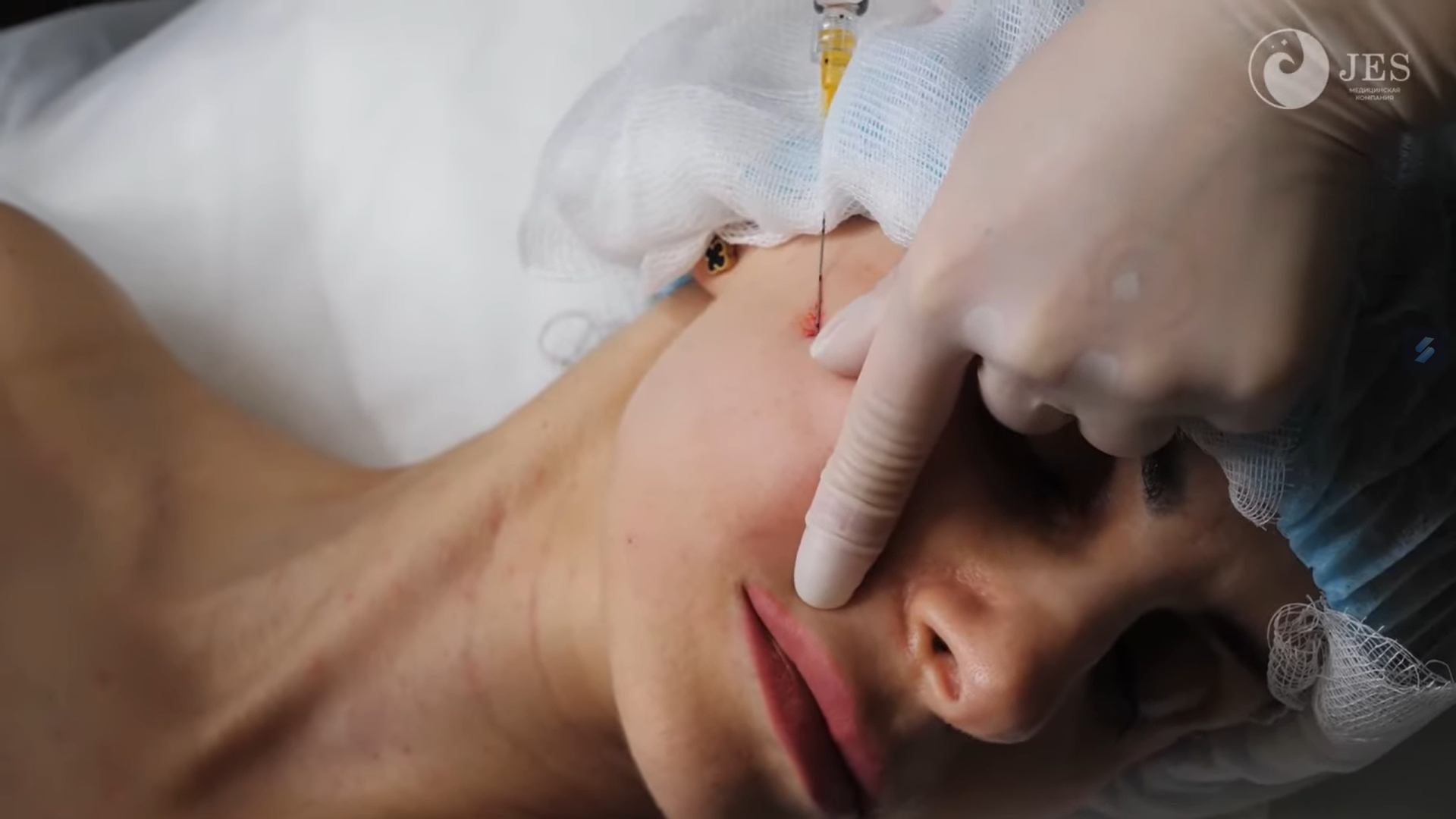 Hình ảnh mô tả cách xác định điểm tiêm Karisma khi không có sơ đồ minh họa, thể hiện tính khoa học của các điểm tiêm Karisma được xác định từ trung tâm ra ngoại biên
