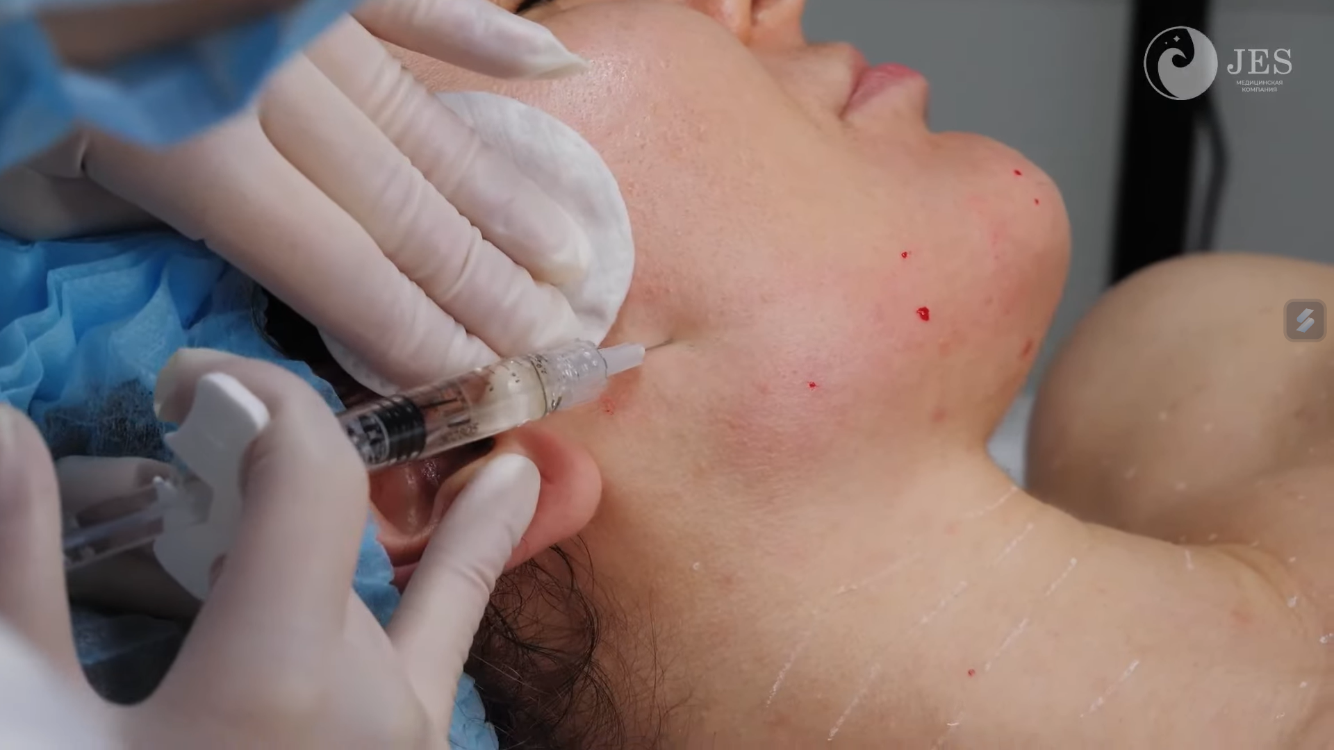 Karisma bao lâu tiêm lại - bổ sung collagen