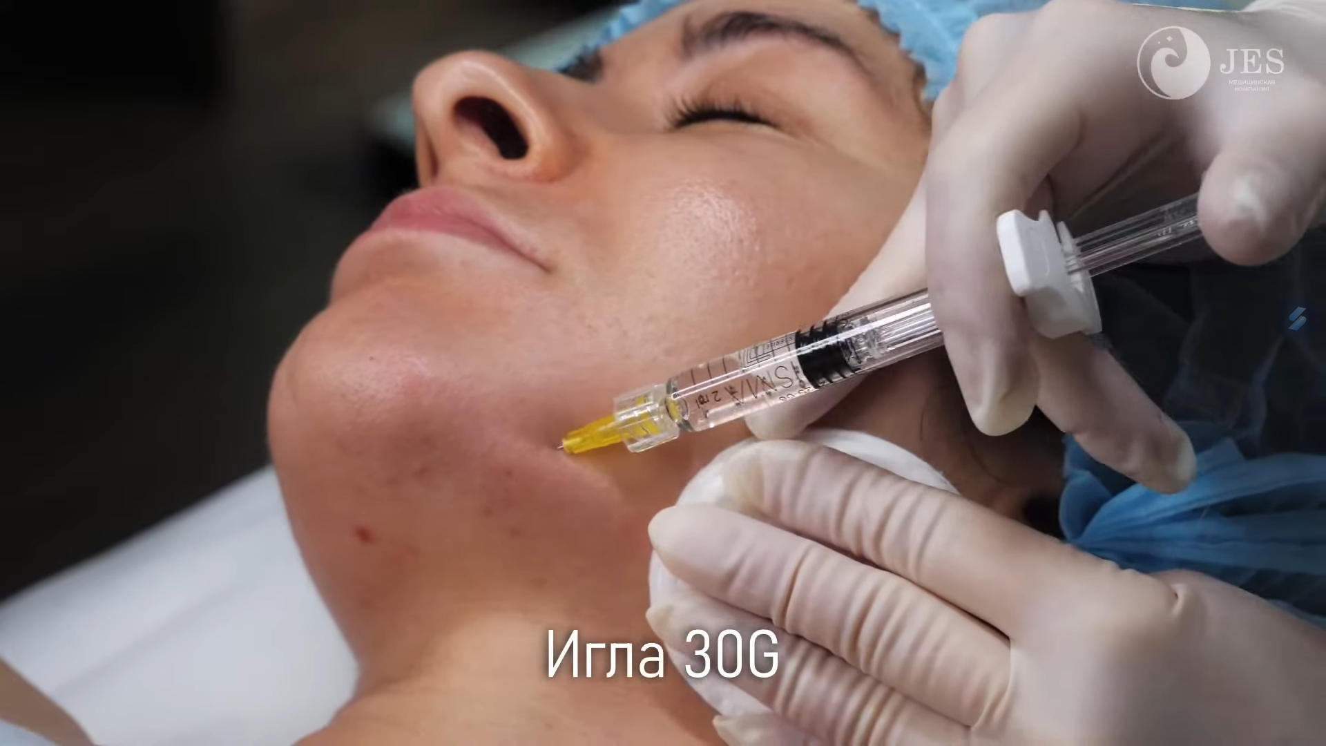 Hình ảnh chuyên sâu minh họa phương pháp chọn đúng điểm tiêm Karisma bằng kim 30G, nhấn mạnh tầm quan trọng của điểm tiêm Karisma cho kết quả tối ưu