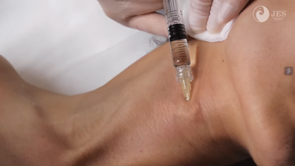 Hình ảnh về quy trình tiêm Karisma minh họa cách đánh giá tiêm Karisma giá bao nhiêu, tiêm BAP Karisma có tác dụng gì, tiêm Karisma bao lâu có tác dụng và tiêm Karisma có đau không.