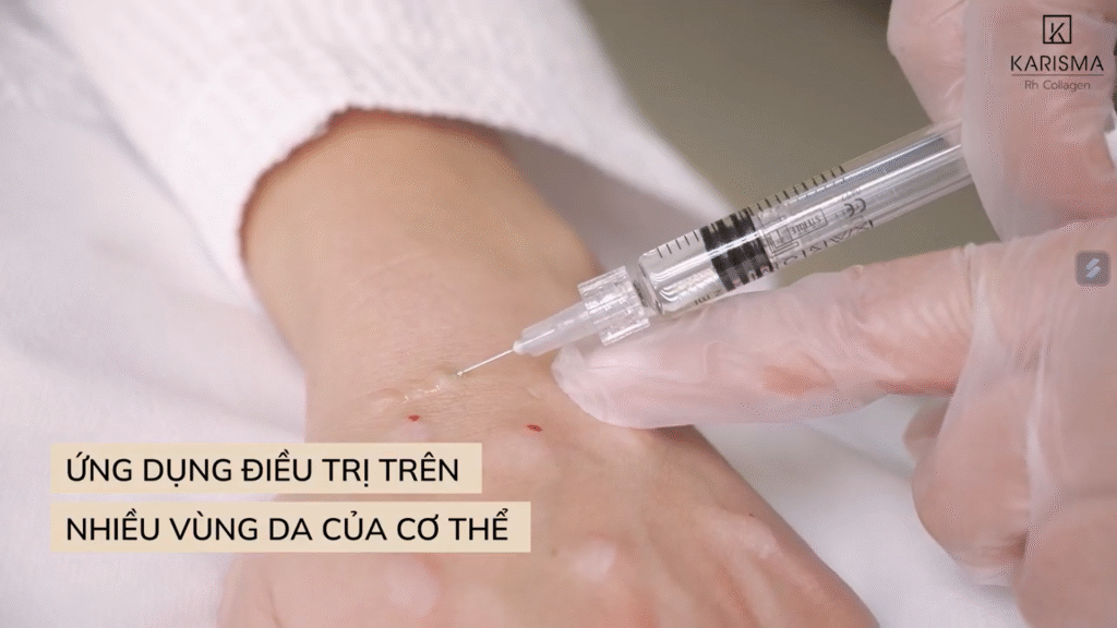 Ứng dụng Karisma vùng tay trong điều trị làm trẻ hóa mu tay giúp cải thiện độ đàn hồi và kết cấu da một cách sinh học và tự nhiên, mang lại vẻ đẹp trẻ trung bền vững.