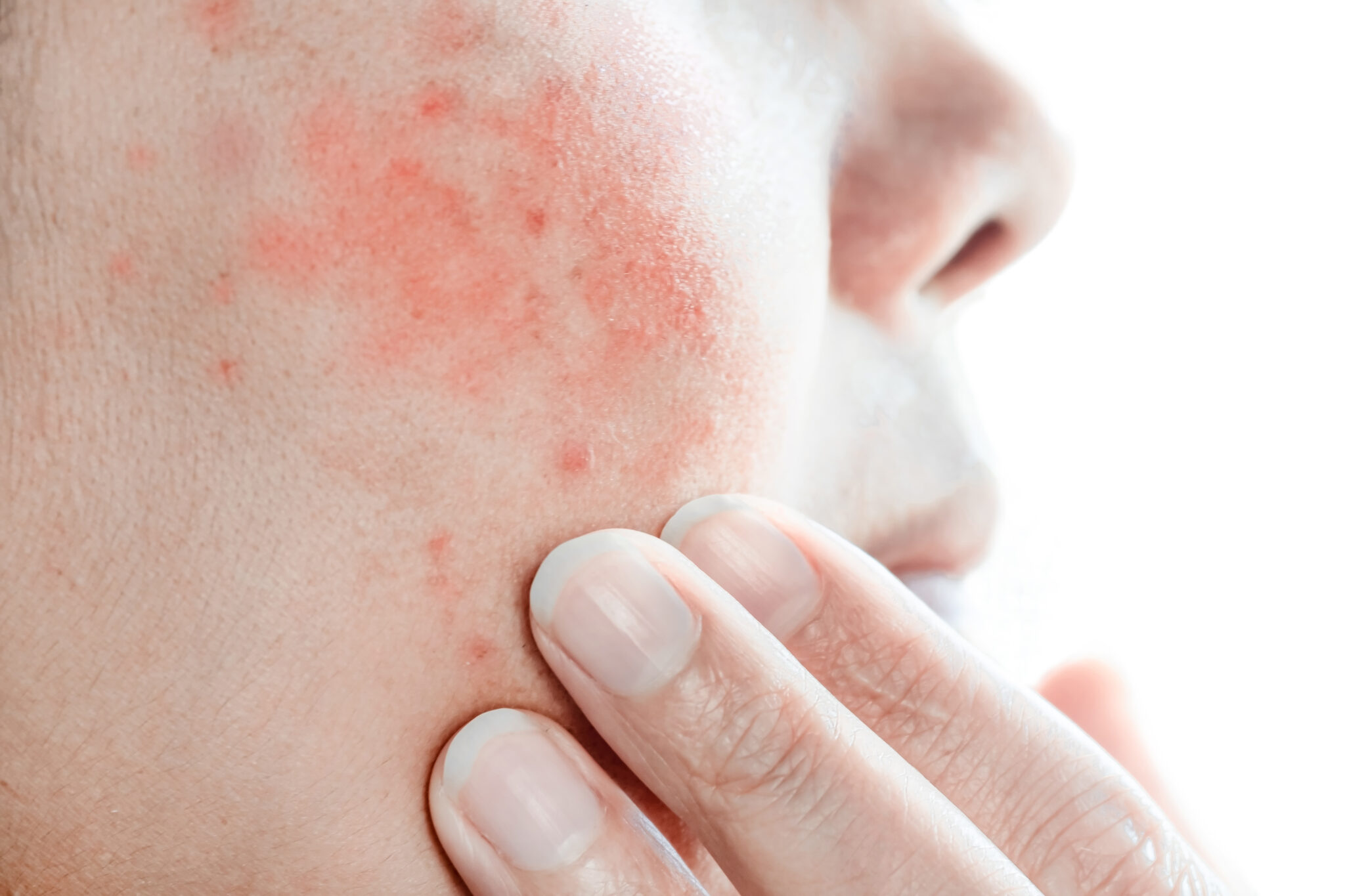 Vi sinh trên da cùng với probiotics cho da bảo vệ hàng rào tự nhiên