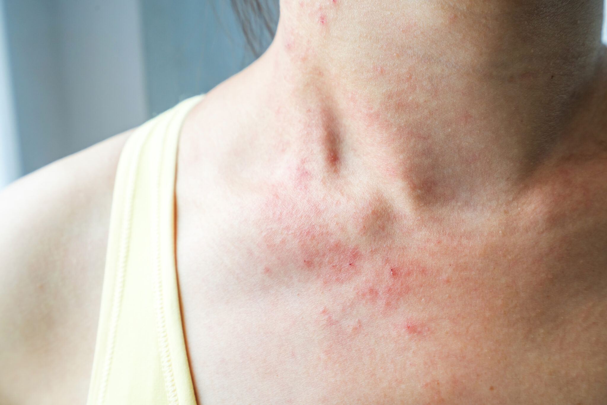 Vi sinh trên da hỗ trợ củng cố hàng rào bảo vệ cùng hệ vi sinh da cân bằng