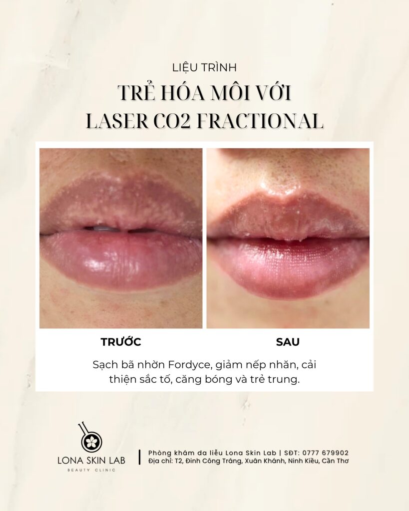 Hình ảnh trước và sau điều trị nám bằng laser toning cho thấy công nghệ laser toning tiên tiến với quy trình laser toning được tuân thủ nghiêm ngặt, đảm bảo hiệu quả laser toning cao và hạn chế tối đa tác dụng phụ laser toning.