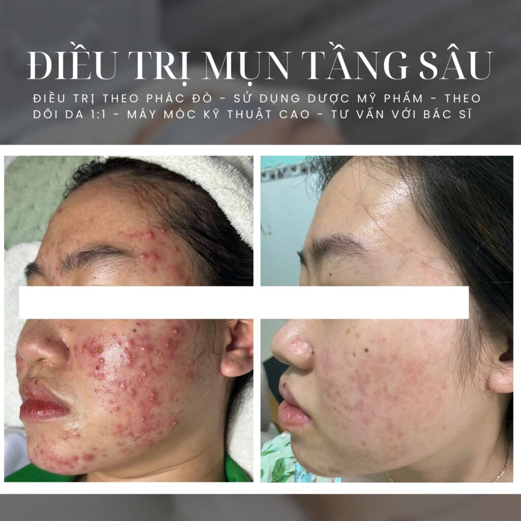 Qua ảnh before_after_mụn_37.jpg, bác sĩ da liễu trị mụn giỏi Cần Thơ chứng tỏ năng lực vượt trội khi bác sĩ da liễu Cần Thơ cùng phòng khám da liễu Cần Thơ triển khai chiến lược trị mụn Cần Thơ hiệu quả, xác nhận danh tiếng của bác sĩ da liễu trị mụn giỏi Cần Thơ.