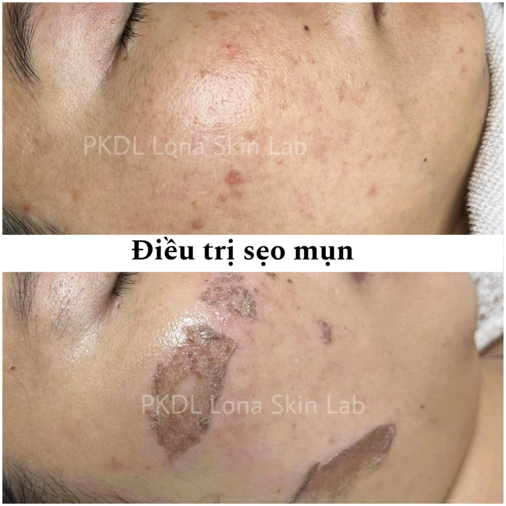 Hình ảnh về Sẹo đa phương pháp với Trị sẹo hiệu quả, Phương pháp trị sẹo tiên tiến hỗ trợ Cách làm mờ sẹo, tạo điều kiện cho Điều trị sẹo tại nhà tối ưu.