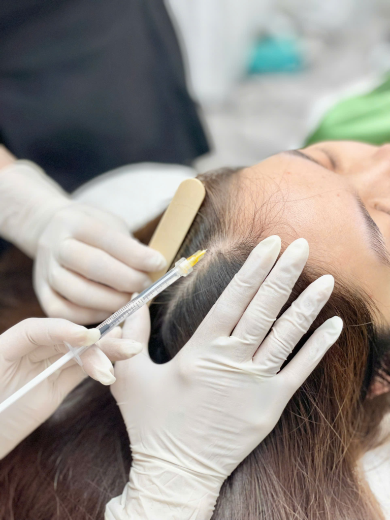 Liệu pháp mesotherapy cho tóc với Meso kích thích mọc tóc và tiêm meso mọc tóc được áp dụng bởi các bác sĩ chuyên khoa da liễu, giúp điều trị rụng tóc bằng meso và cải thiện sự phát triển của nang tóc.