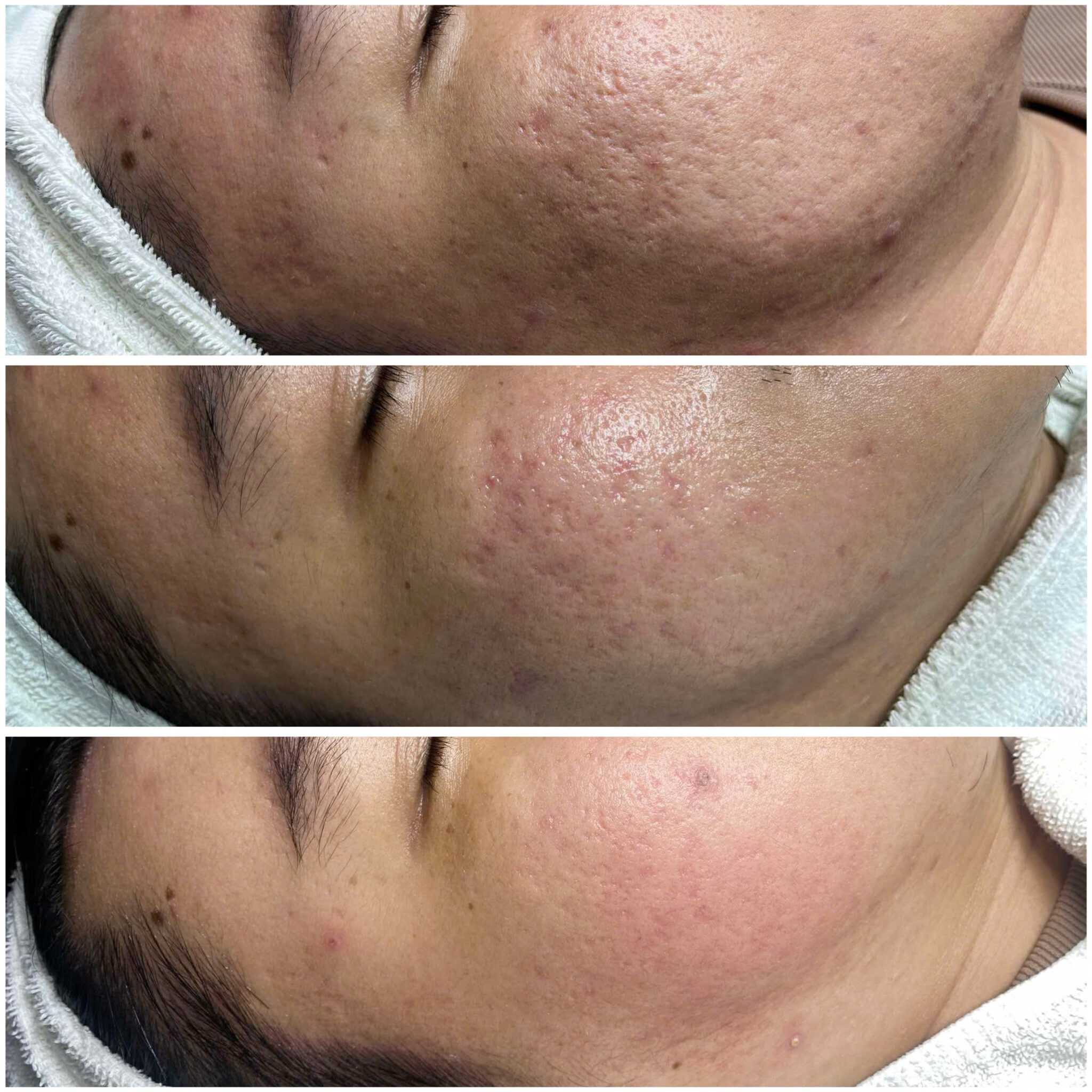 Phòng khám đang trong liệu trình điều trị sẹo rỗ Cần Thơ