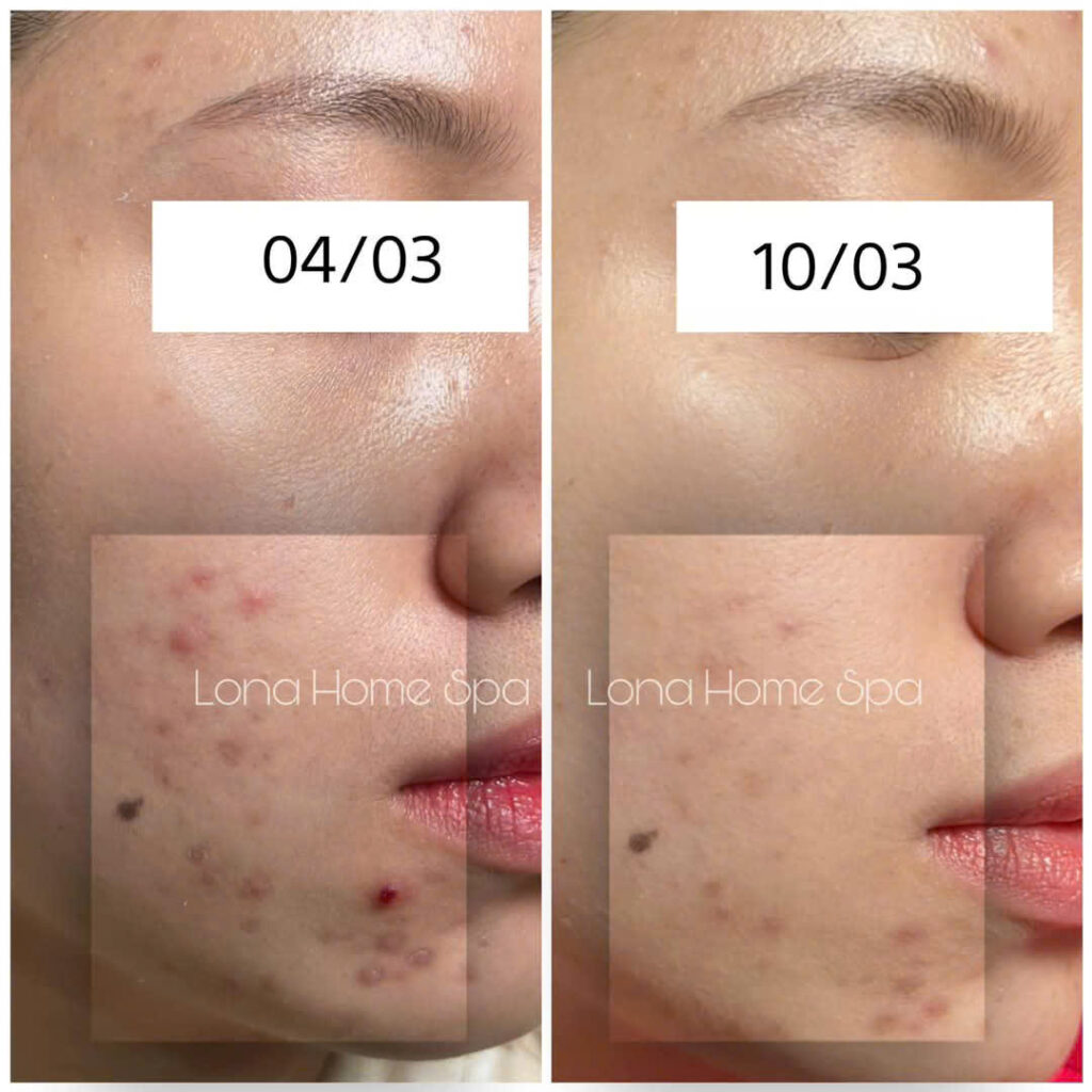 Đánh giá nguy cơ tăng sắc tố sau viêm trước laser