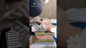 Một buổi điều trị mụn bằng ánh sáng kép kết hợp peel tại Lona