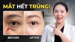 Karisma: Giải pháp mới cho vùng trũng mắt bạn cần biết