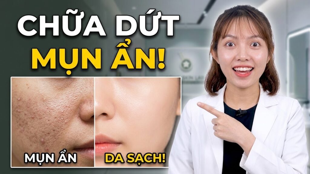 Mình bị mụn ẩn hoài không hết phải làm sao?