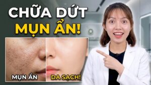 Mình bị mụn ẩn hoài không hết phải làm sao?