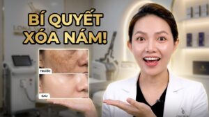 Mình bị nám sau sinh phải làm sao?