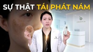 Nám quay trở lại sau điều trị: Sai lầm ở đâu?