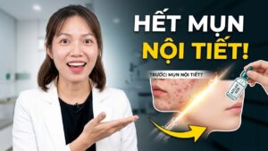 Mình bị mụn nội tiết phải làm sao