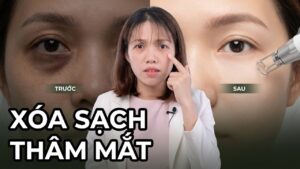 Mình bị thâm mắt phải làm sao