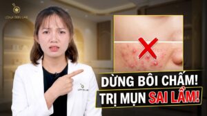 Mình bị mụn viêm sưng phải làm sao?