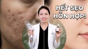 Bị sẹo hỗn hợp lâu năm phải làm sao?
