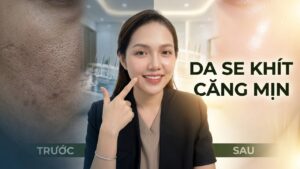 RF Needle: Giải pháp cứu cánh cho da sẹo và lỗ chân lông to?
