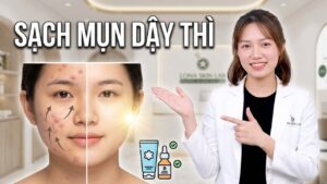 Con vào tuổi mụn dậy thì phải làm sao?