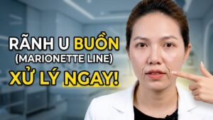 Tôi có rãnh u buồn phải làm sao?
