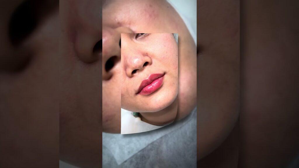 Chỉnh môi lệch do giật cơ